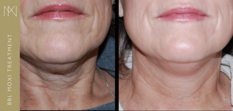BBl Moxi Treatment in London
