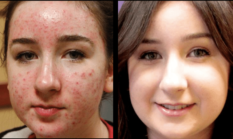 Sciton BBL Hero London Acne treatment