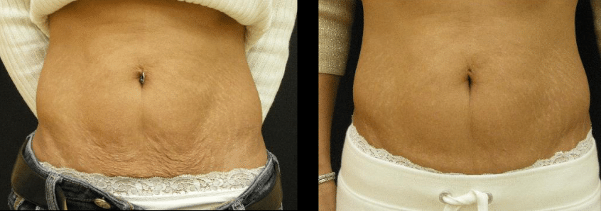 BBL Moxi laser skintyte treatment 