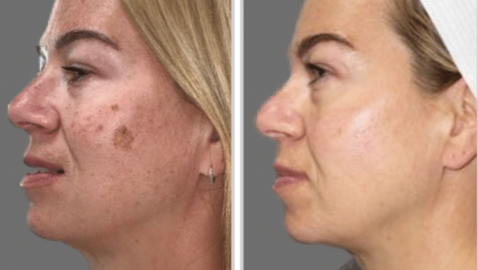 BBL and moxi treatment in London