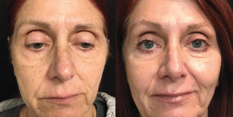 Forever young BBL treatment surrey