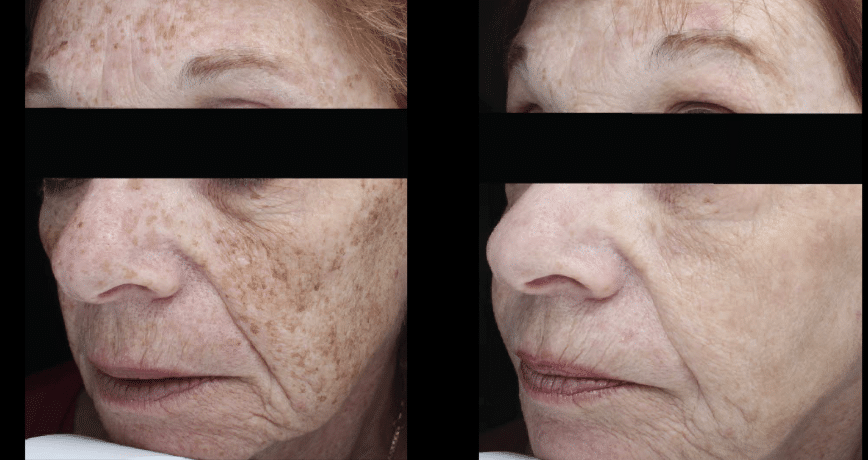 forever young treatment surrey