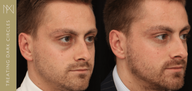 dark circles before and after surrey