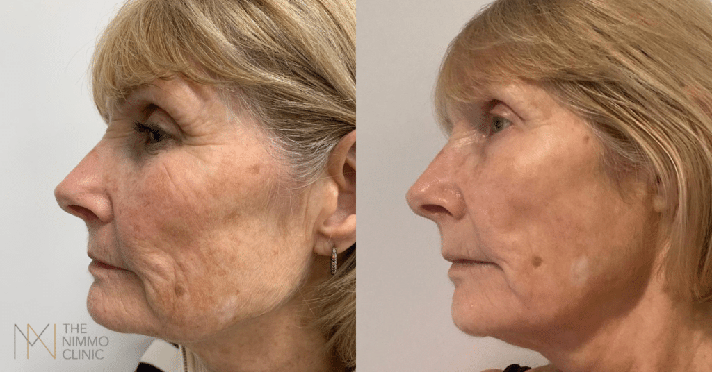 before and after bbl moxi treatment surrey