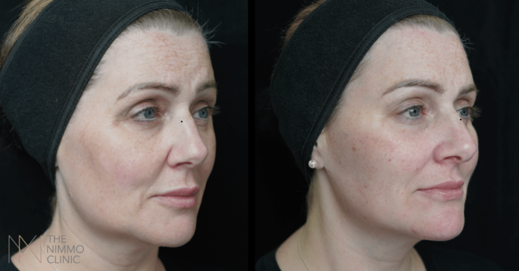 treatment for dark circles in surrey