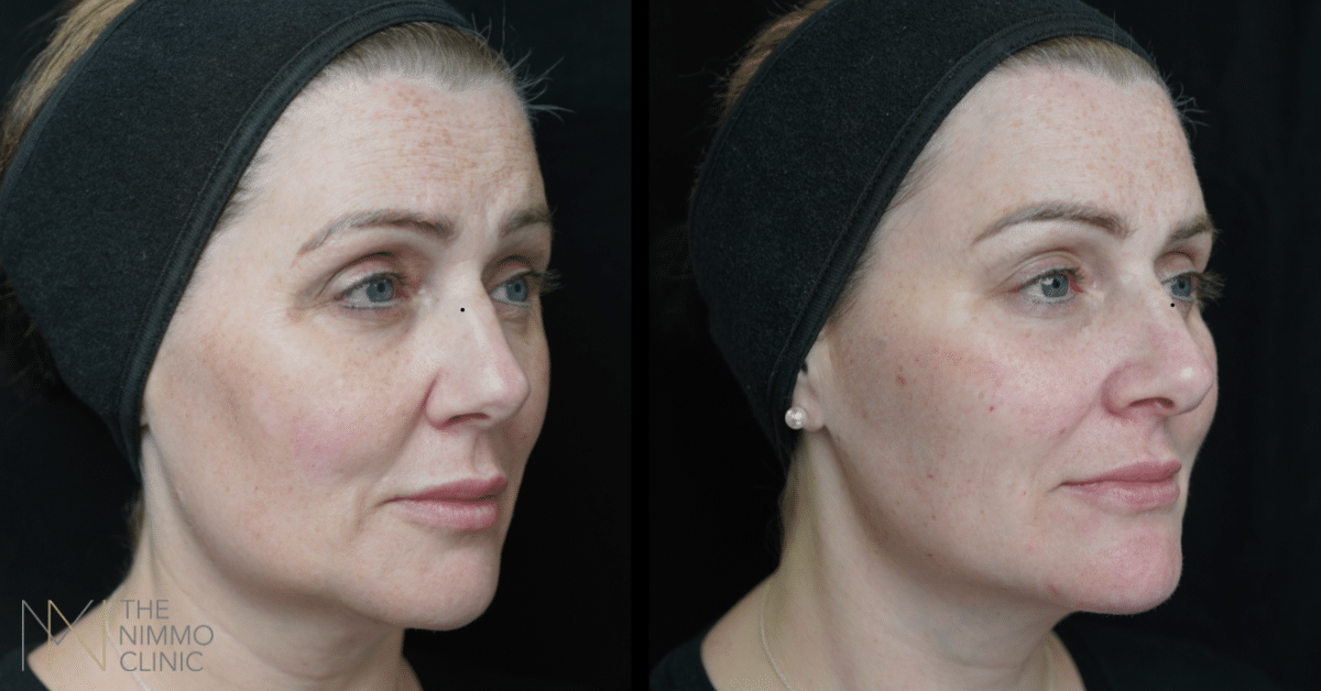 treatment for dark circles in surrey
